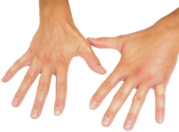 comparing-swollen-knuckles-on-male-hands-isolated-on-stock-photo