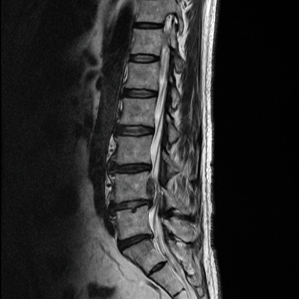 MRI of a herniated disc on the LWS - Stock Photo #15202613 ...