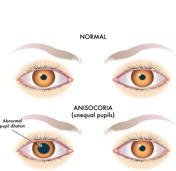 medical illustration of symptoms of unequal pupils - Royalty free photo ...