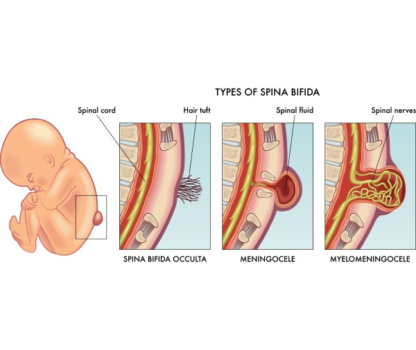 medical illustration of infant spina bifida
