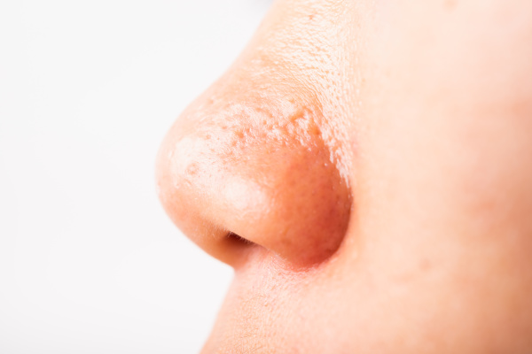 woman large pores have freckles cheek