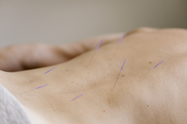 acupuncture acupuncture needle during treatment