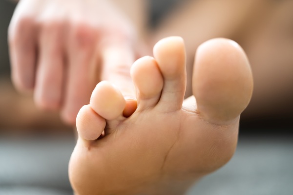 athlete foot fungal infection