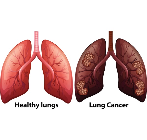 human anatomy of lung condition