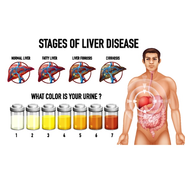 Stages of liver disease - Stock image #30249746 | PantherMedia Stock Agency