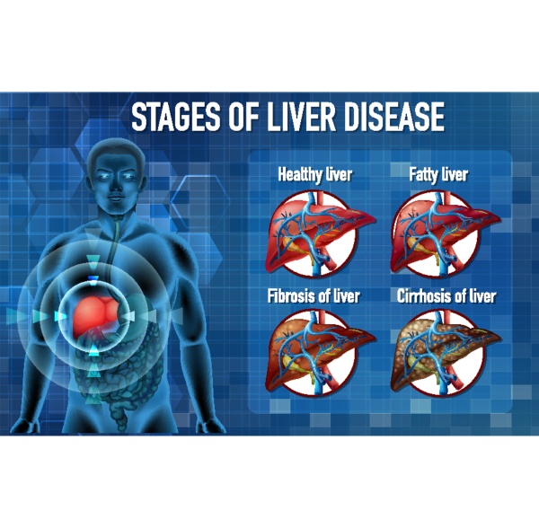 Stages of liver disease - Royalty free photo #30264392 | PantherMedia ...