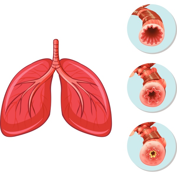 Stages of block airway to lungs - Stock image #30275038 | PantherMedia ...