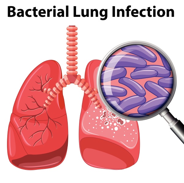 a bacterial lung infection on white