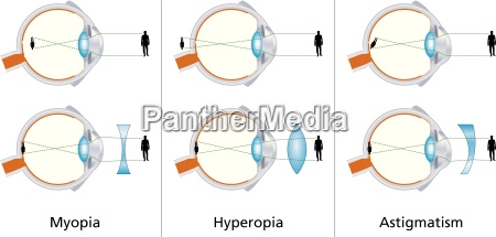 myopia hyperopia színvakság asztigmatizmus