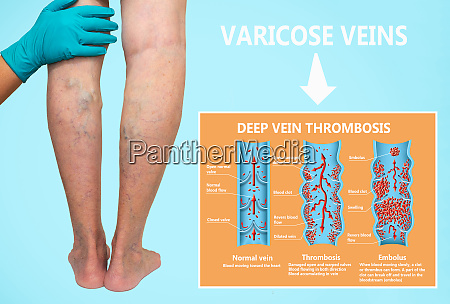 thrombosis. From Normal blood flow to Blood clot - Royalty free photo ...