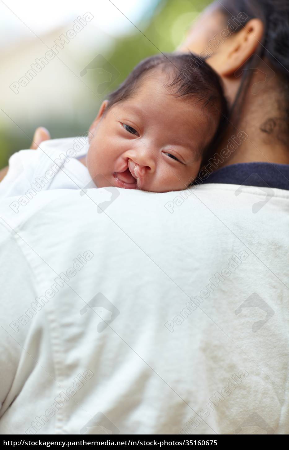 Portrait Cleft Palate And Baby With Health Care And - Royalty Free 